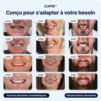 Facettes dentaires