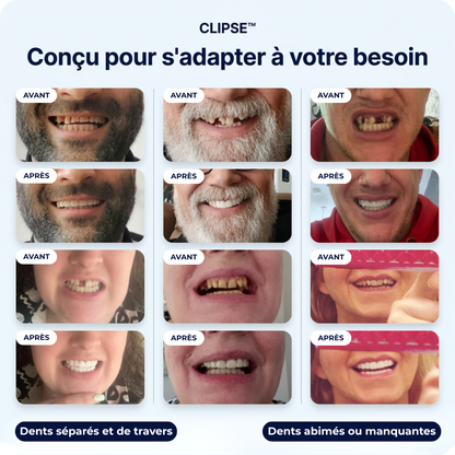 Facettes dentaires