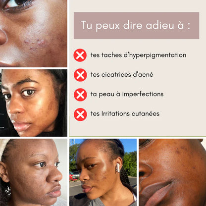 Routine Anti-imperfection 4 en 1 (1 ACHETÉ = 1 OFFERT)