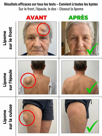 Boule Anti-Lipome – Aide à éliminer les Boules Sous la Peau naturellement