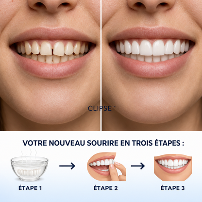 Facettes dentaires